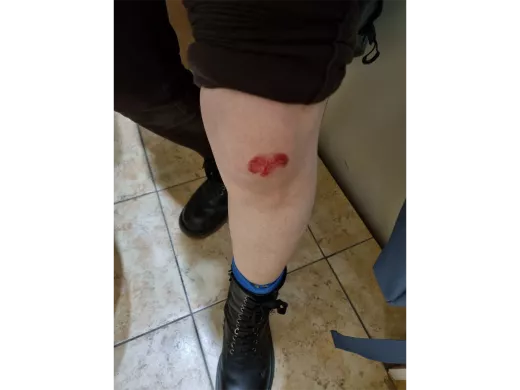 Petersburg, Tsyren-Dulma Lubsanova, the leg was injured during detention. February 27, 2022 / Photo provided by Lubsanova