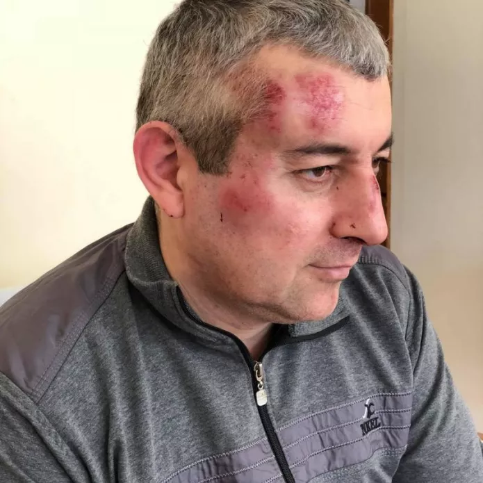 28 марта 2018 года неизвестный напал на руководителя представительства Правозащитного центра «Мемориал» в Махачкале Сиражутдина Дациева / Фото: Екатерина Сокирянская