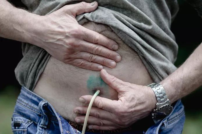 Igor Baryshnikov demonstrates his suprapubic cystostomy, a catheter inserted into the bladder and passing through the abdominal wall / Photo: OVD-Info